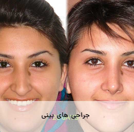 نمونه جراحی های بینی