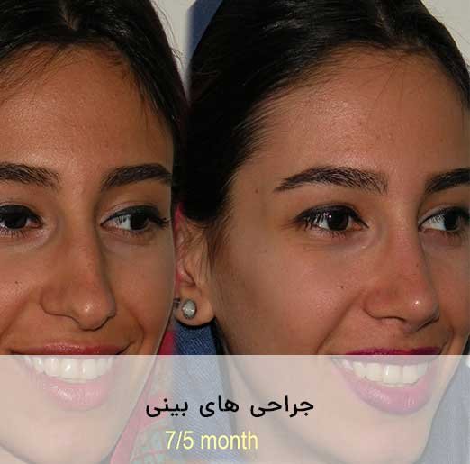 نمونه جراحی های بینی
