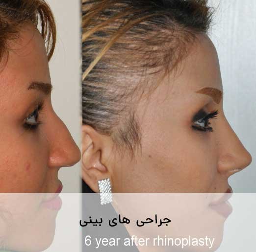 نمونه جراحی های بینی
